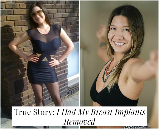 True Story: I Had My Breast Implants Removed 